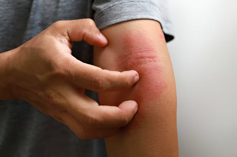 How to Prevent Eczema Naturally