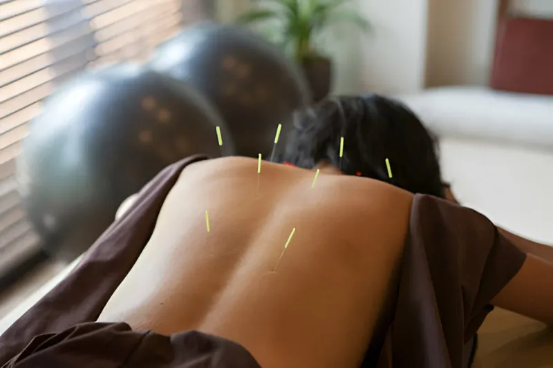 Beyond The Needles: Unveiling Top 10 Benefits Of Acupuncture