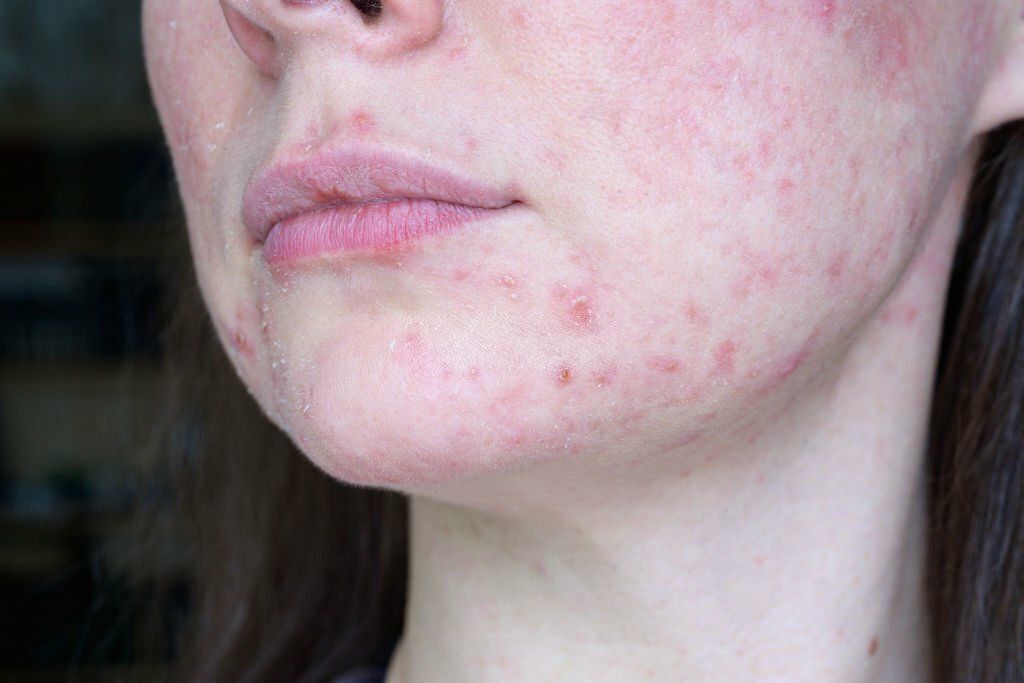 Reclaiming Skin Health Signs Perioral Dermatitis