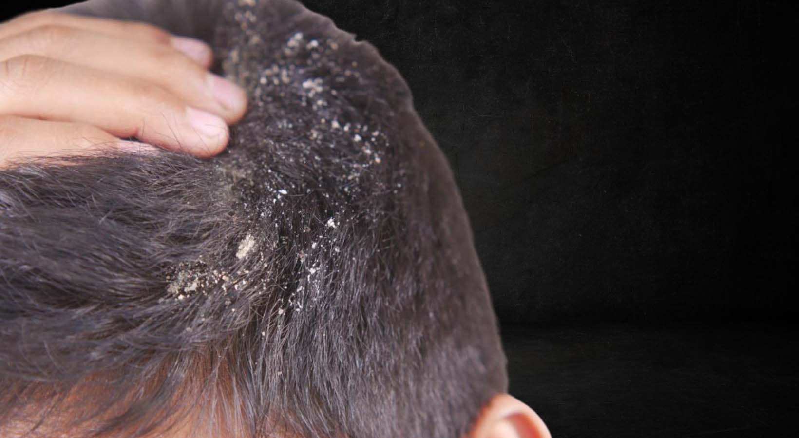 Cracking the Code: Is Dandruff Genetic?