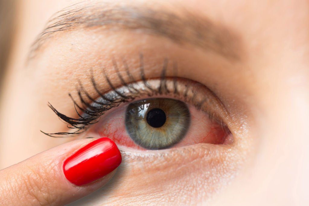 4 Eye Conditions That Are Often Mistaken as Pink Eye
