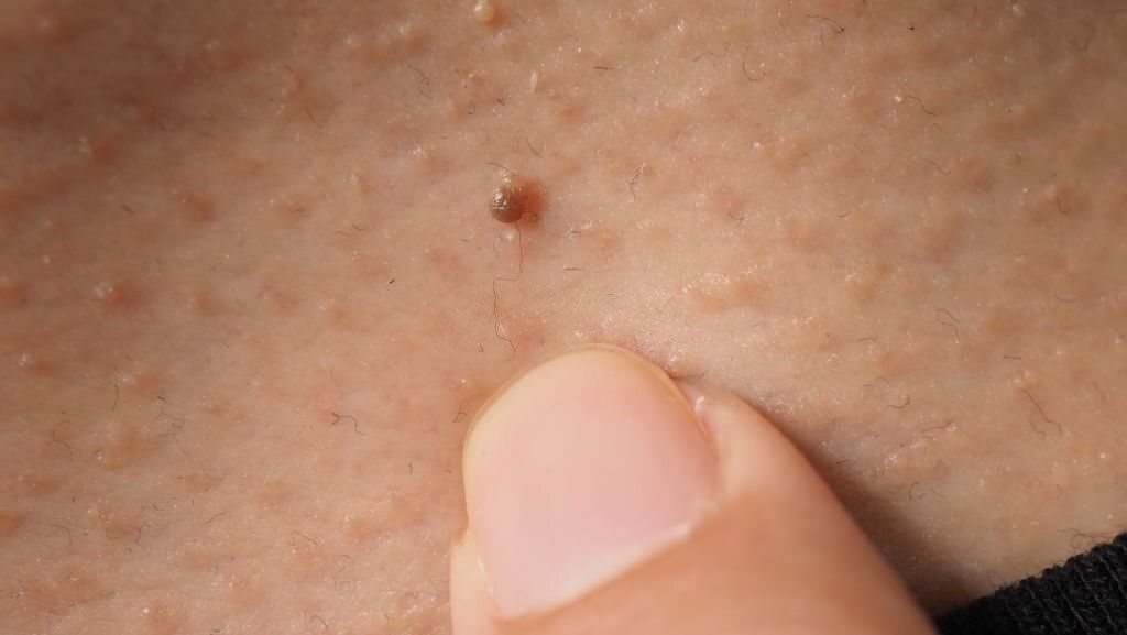 Skin Tag Cancer: Causes, Symptoms & Treatment Options