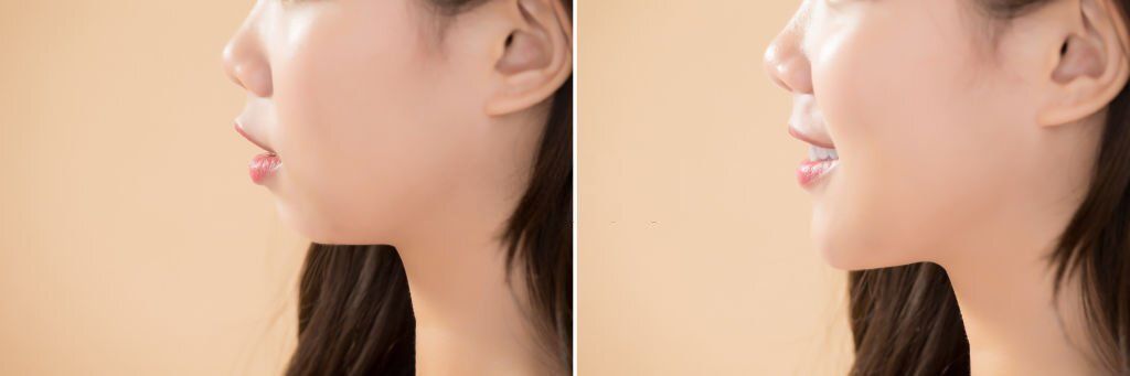 Breaking Down Double Jaw Surgery: What You Need To Know!