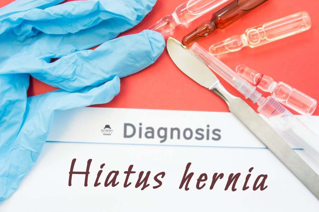Small to Large: What Size Hiatal Hernia Needs Surgery?