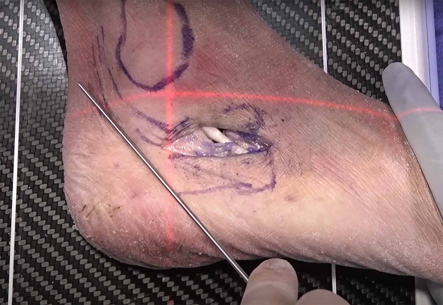 Flat Feet Surgery Pros And Cons: What You Need To Know?