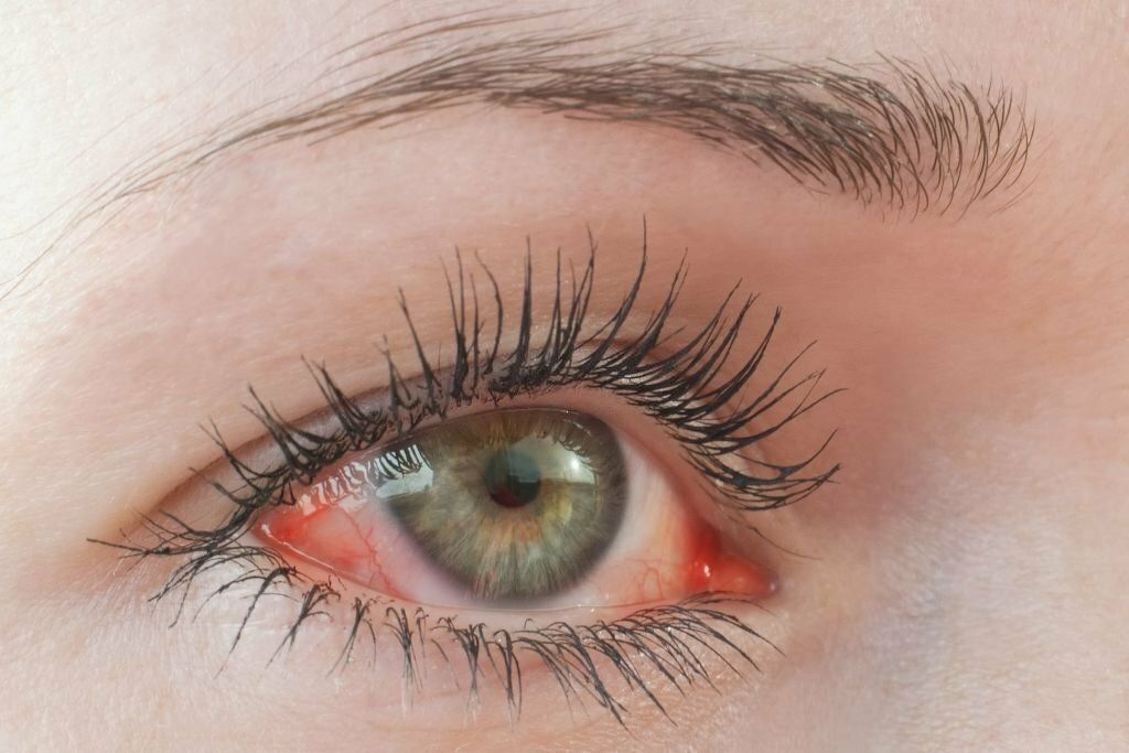 Unveiling the Silent Threat: Can Dry Eyes Cause Blindness?