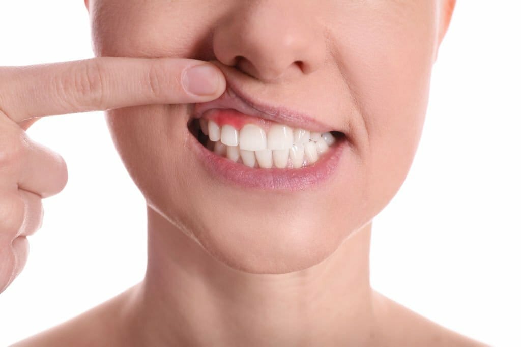 Say Goodbye to Gum Disease: Gingivitis Before and After