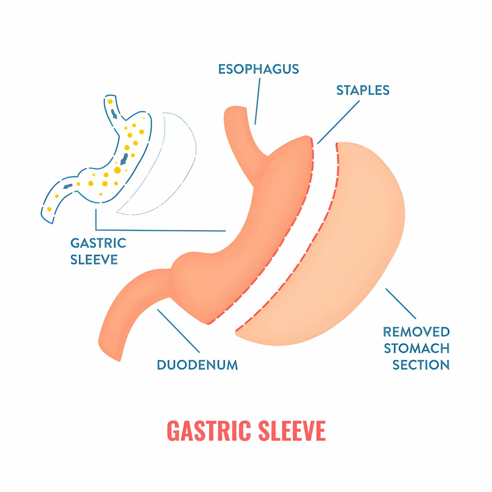 How To Avoid Dental Problems After Gastric Sleeve