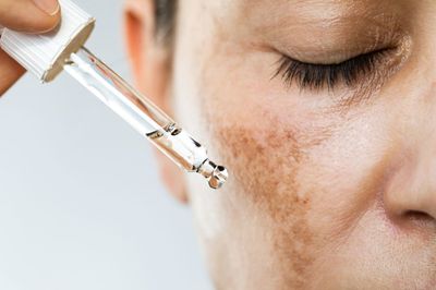 Sunspots on Skin: Causes, Symptoms, Treatment & Prevention