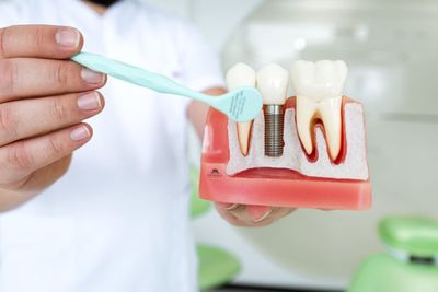 6 Types of Dental Implants: Pros-Cons & How They Work?