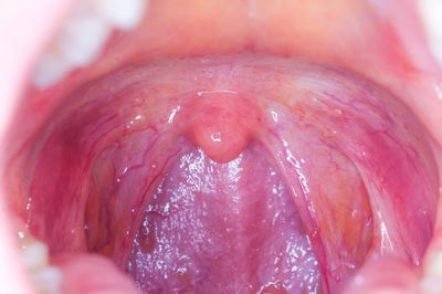 Debunking Tonsil Myths: Can Tonsils Grow Back?