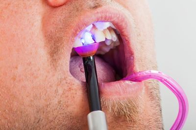 Teeth Bonding Before and After: How It Can Transform Your Smile?