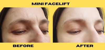 7 Things to Remember Before and After a Mini Facelift