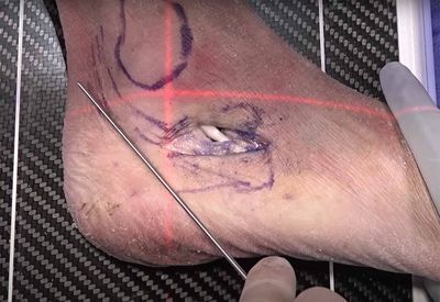 Flat Feet Surgery Pros And Cons: What You Need To Know?