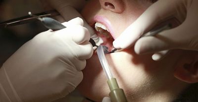 Root Canal Before And After: How to Deal with It?