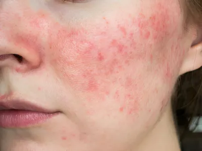 Taming The Redness: Natural Remedies For Rosacea Flare Ups