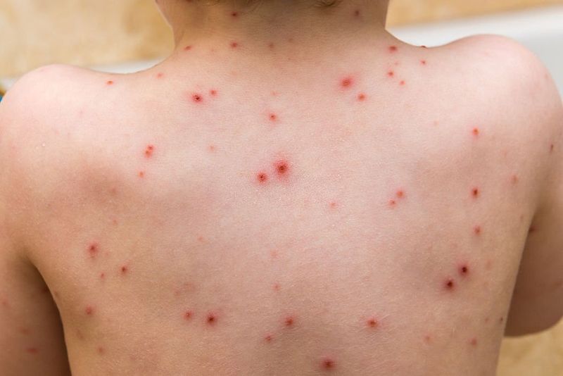 Preventing & Treating Chicken Pox Scars: Tips & Remedies