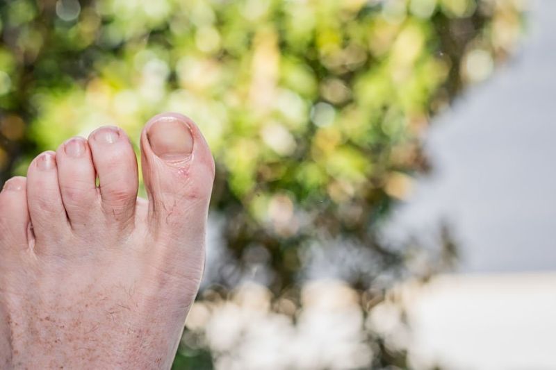 What Causes Hyperpigmentation On Toes?