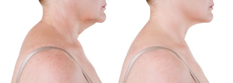 Neck Lift Before and After: A New Look For A Younger You