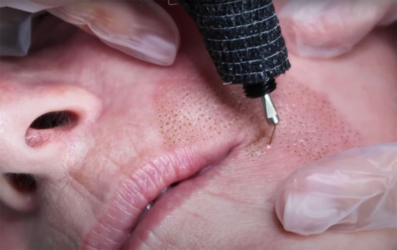 Plasma Fibroblast Before and After: Is It Bad for Your Skin?