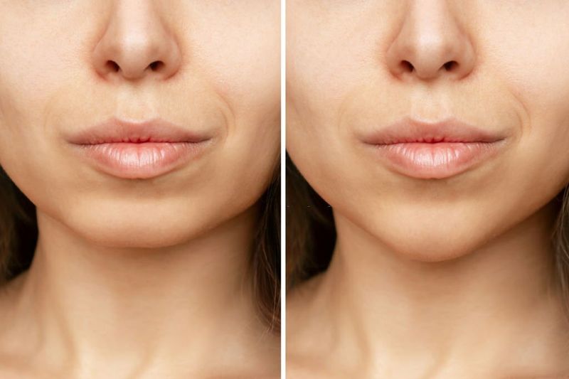 Get A Perfect Chin With Genioplasty Before and After