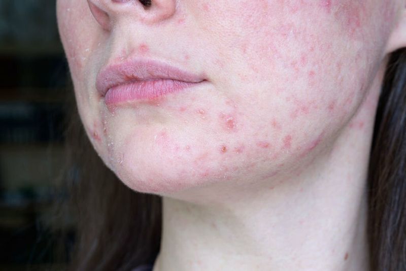 Reclaiming Skin Health: Signs Perioral Dermatitis Is Healing