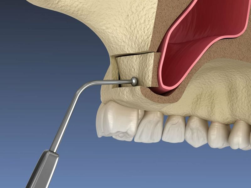Sinus Lift Surgery: Risks, Benefits & Alternatives