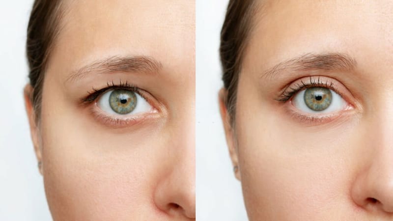 Revamping Your Look: The Power of Brow Lift Before and After