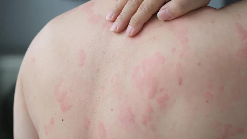 Best Essential Oils For Urticaria